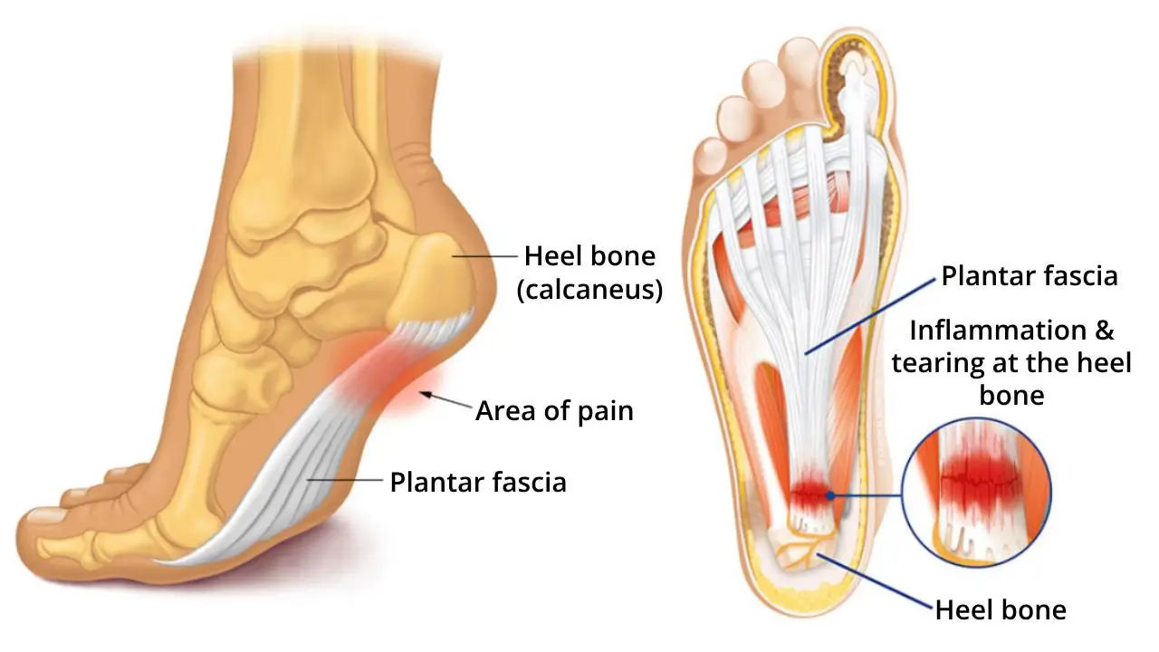 Revolutionaire orthopedische binnenzool